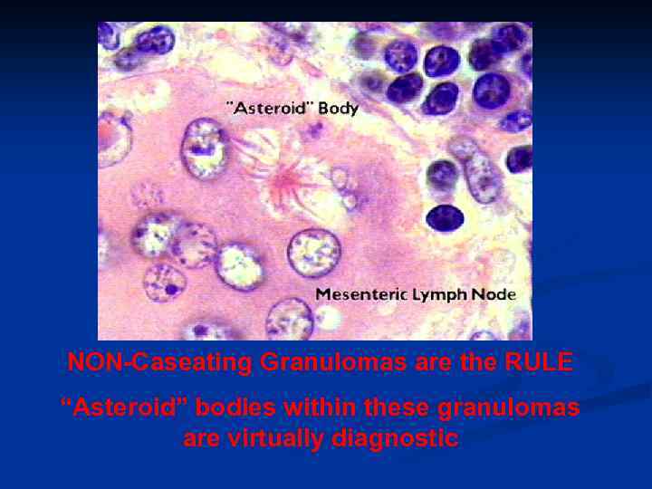 NON-Caseating Granulomas are the RULE “Asteroid” bodies within these granulomas are virtually diagnostic 