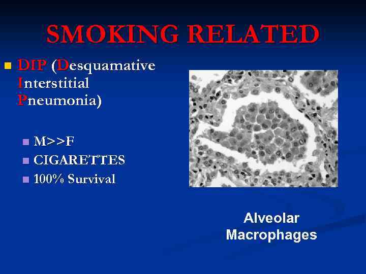 SMOKING RELATED n DIP (Desquamative Interstitial Pneumonia) M>>F n CIGARETTES n 100% Survival n