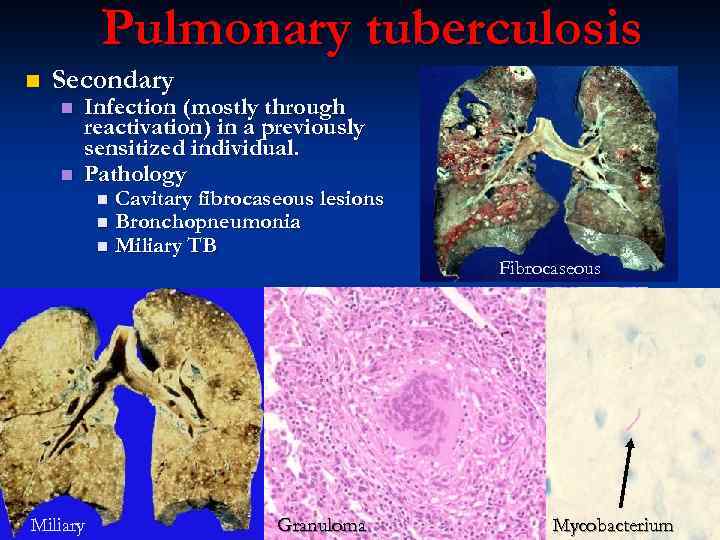 Pulmonary tuberculosis n Secondary n n Infection (mostly through reactivation) in a previously sensitized