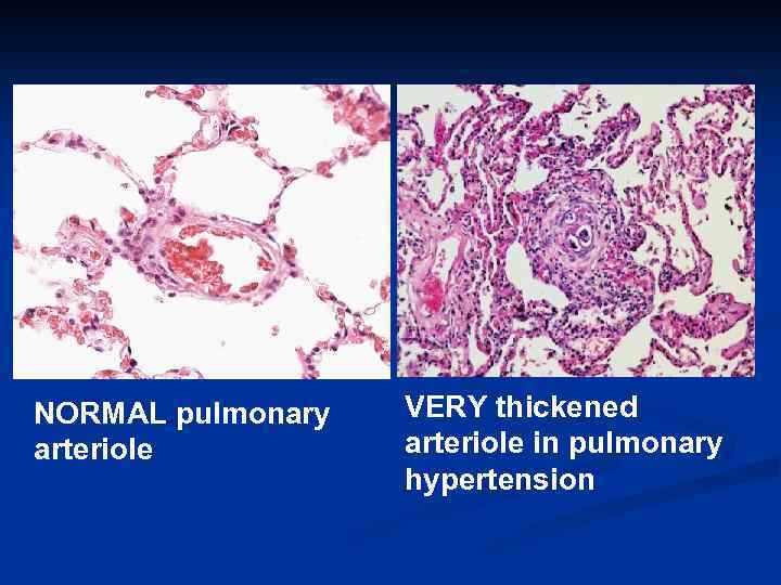 NORMAL pulmonary arteriole VERY thickened arteriole in pulmonary hypertension 