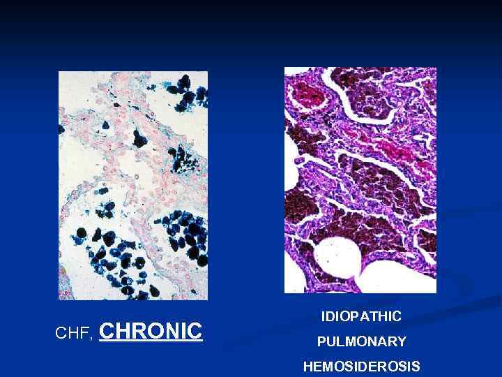 CHF, CHRONIC IDIOPATHIC PULMONARY HEMOSIDEROSIS 