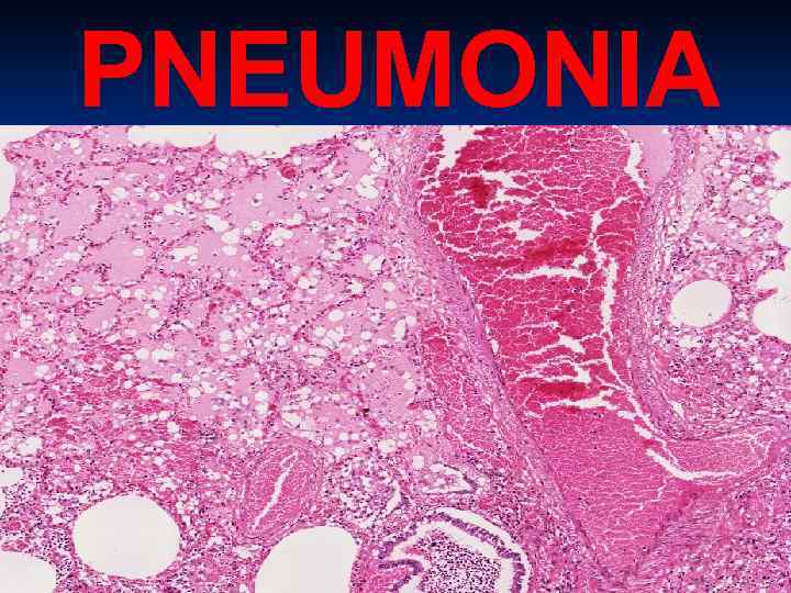 PNEUMONIA 