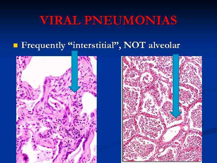 VIRAL PNEUMONIAS n Frequently “interstitial”, NOT alveolar 