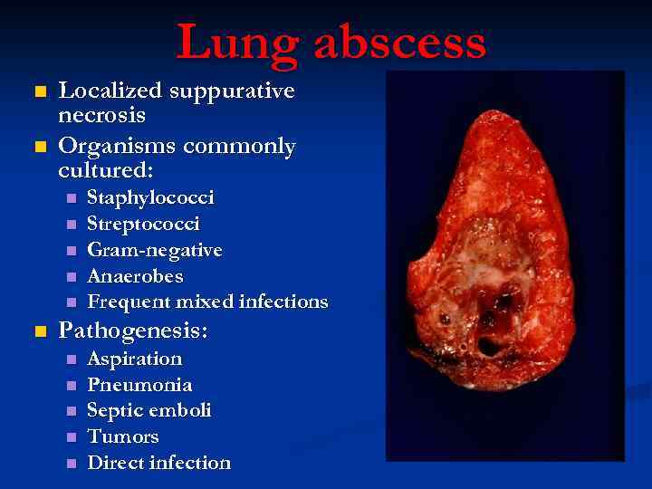 Lung abscess n n Localized suppurative necrosis Organisms commonly cultured: n n n Staphylococci