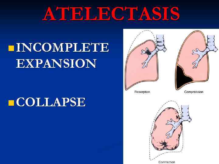 ATELECTASIS n INCOMPLETE EXPANSION n COLLAPSE 