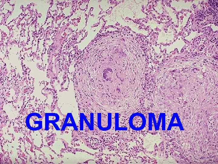 GRANULOMA 