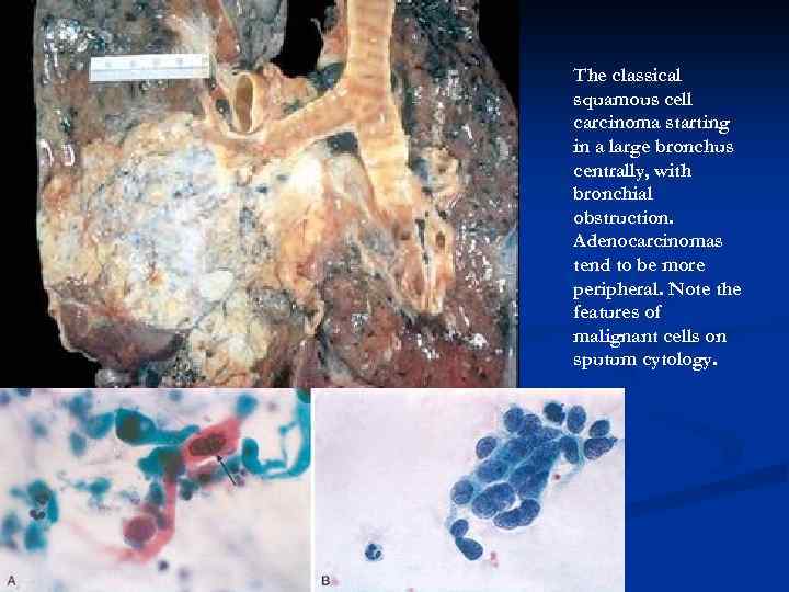 The classical squamous cell carcinoma starting in a large bronchus centrally, with bronchial obstruction.