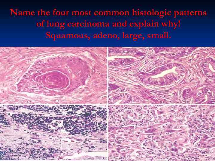 Name the four most common histologic patterns of lung carcinoma and explain why! Squamous,