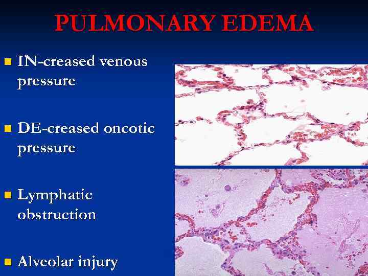 PULMONARY EDEMA n IN-creased venous pressure n DE-creased oncotic pressure n Lymphatic obstruction n