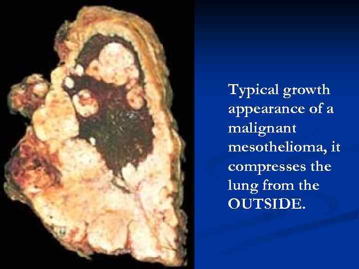 Typical growth appearance of a malignant mesothelioma, it compresses the lung from the OUTSIDE.