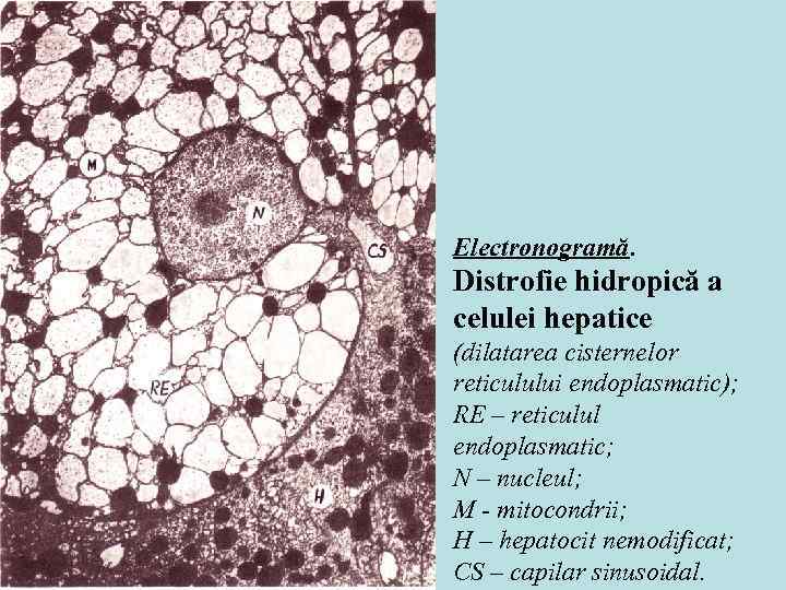 Electronogramă. Distrofie hidropică a celulei hepatice (dilatarea cisternelor reticulului endoplasmatic); RE – reticulul endoplasmatic;
