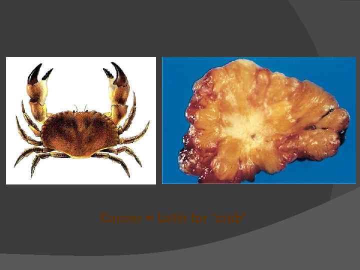 Cancer = Latin for “crab” 