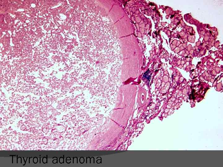 Thyroid adenoma 