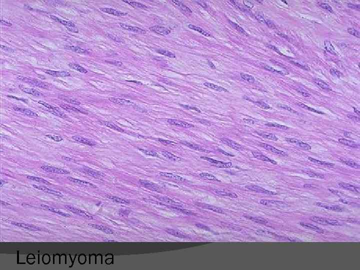 Leiomyoma 