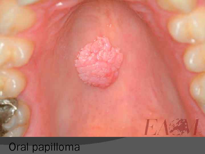 Oral papilloma 