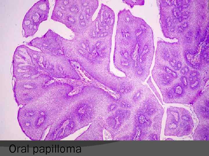 Oral papilloma 