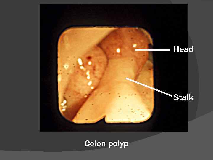 Head Stalk Colon polyp 