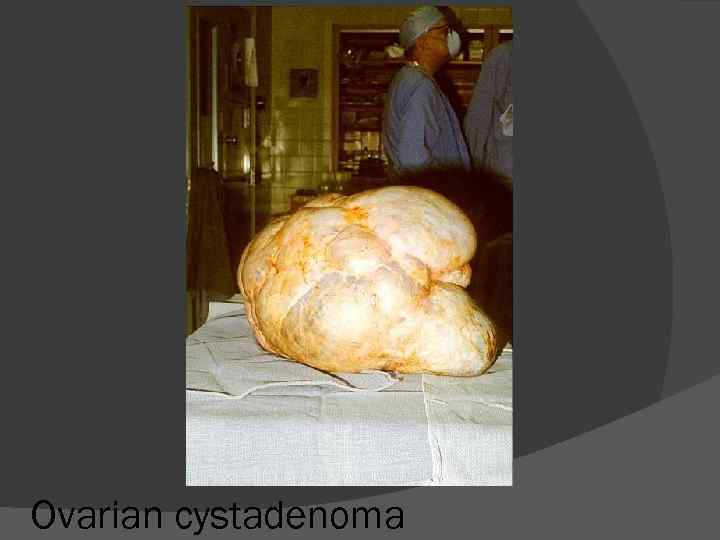 Ovarian cystadenoma 