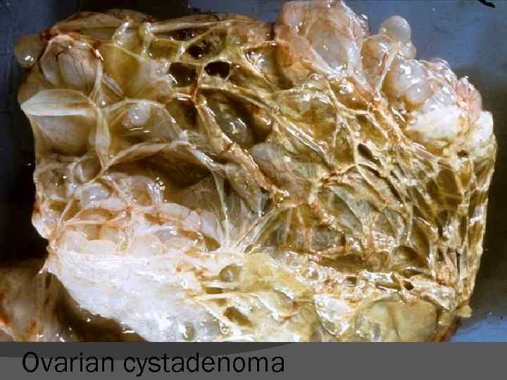 Ovarian cystadenoma 
