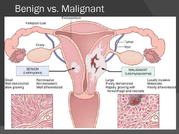 Benign vs. Malignant 