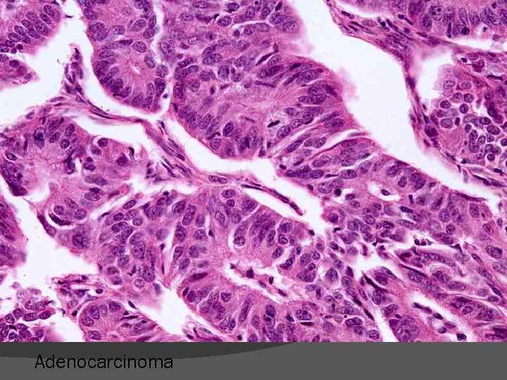Adenocarcinoma 