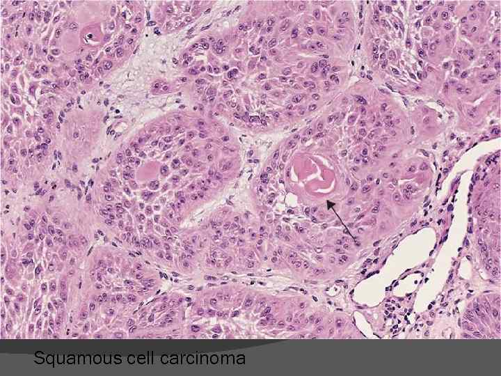Squamous cell carcinoma 