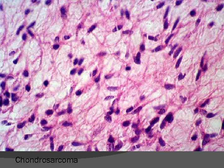 Chondrosarcoma 