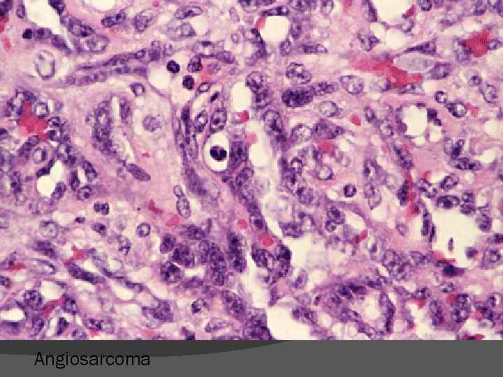 Angiosarcoma 