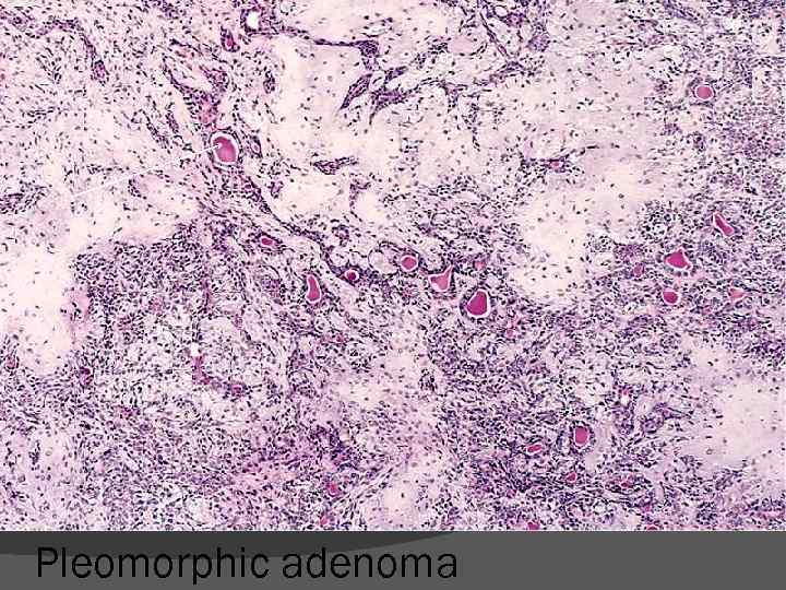 Pleomorphic adenoma 