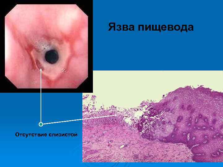 Язва пищевода Отсутствие слизистой 