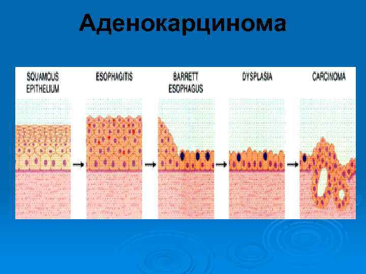 Аденокарцинома 