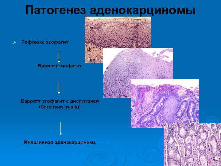 Патогенез аденокарциномы Ø Рефлюкс эзофагит Барретт эзофагит с дисплазией (Carcinom in-situ) Инвазивная аденокарцинома 