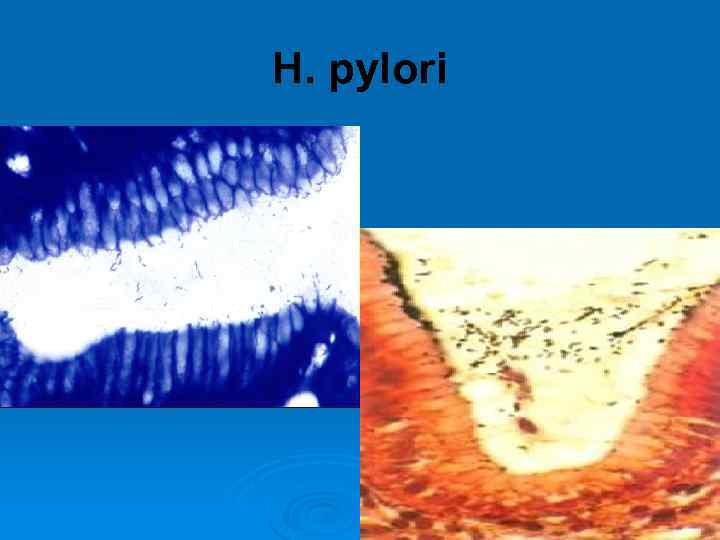 H. pylori 