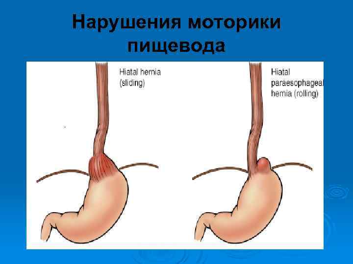 Нарушение моторики. Нарушение перистальтики пищевода. Нарушение моторной функции пищевода. Нарушена перистальтика пищевода. Нарушение моторики пищевода.