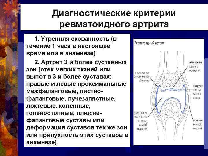 Диагностические критерии ревматоидного артрита 1. Утренняя скованность (в течение 1 часа в настоящее время