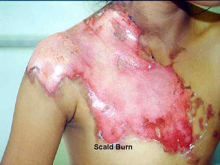 l Scald Burn 