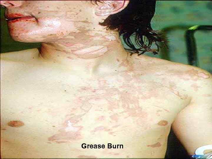 l Grease Burn 
