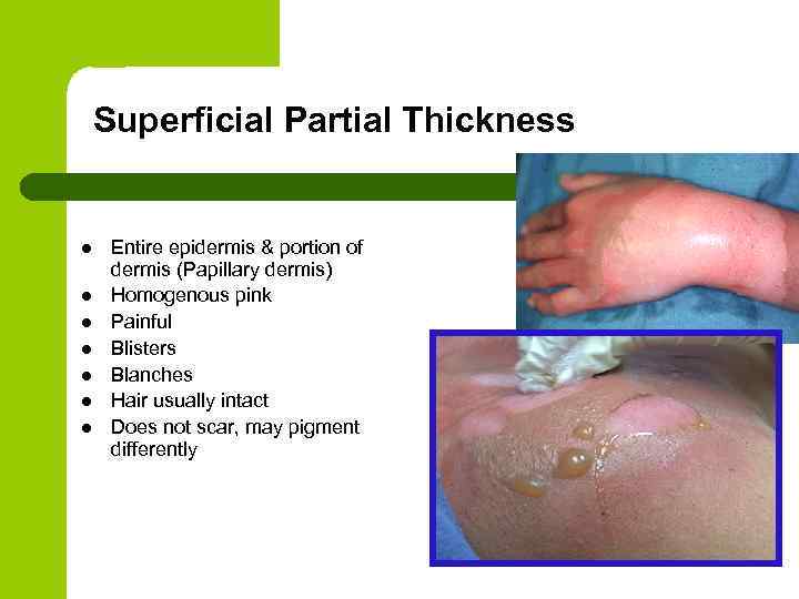 Superficial Partial Thickness l l l l Entire epidermis & portion of dermis (Papillary