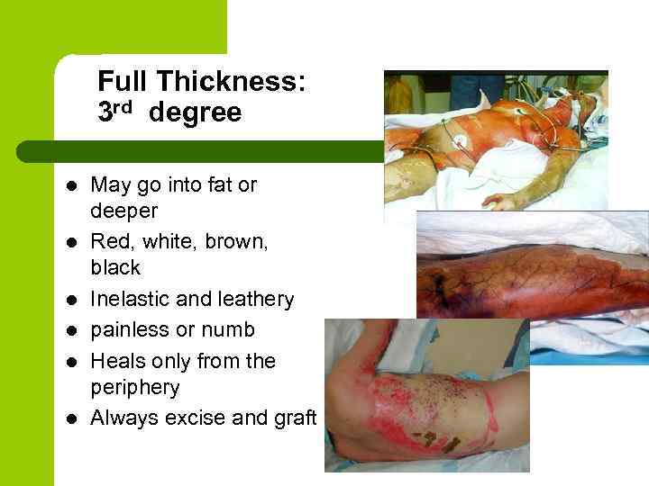Full Thickness: 3 rd degree l l l May go into fat or deeper
