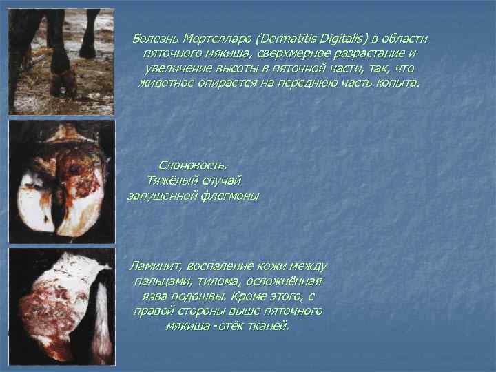 Болезнь Мортелларо (Dermatitis Digitalis) в области пяточного мякиша, сверхмерное разрастание и увеличение высоты в