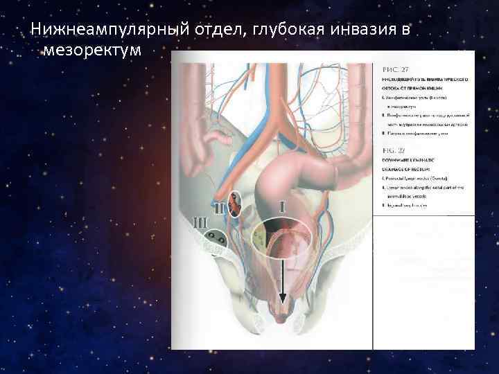 Нижнеампулярный отдел, глубокая инвазия в мезоректум 