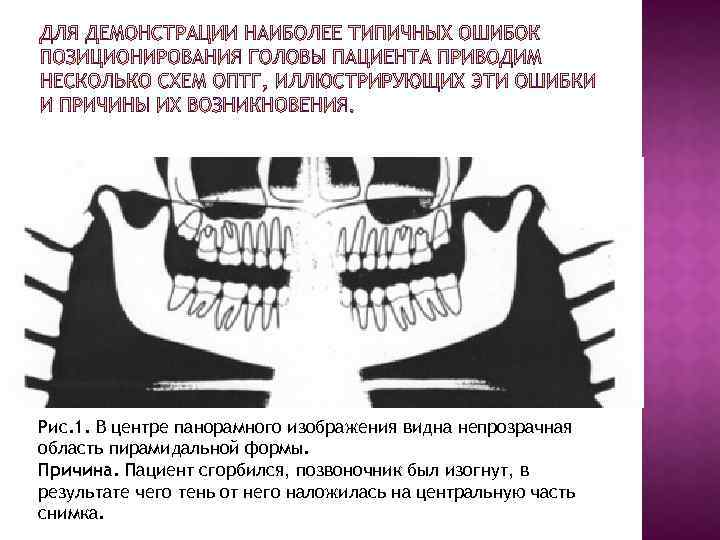 Рис. 1. В центре панорамного изображения видна непрозрачная область пирамидальной формы. Причина. Пациент сгорбился,