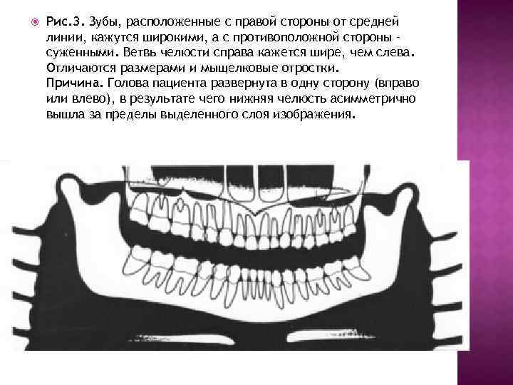  Рис. 3. Зубы, расположенные с правой стороны от средней линии, кажутся широкими, а