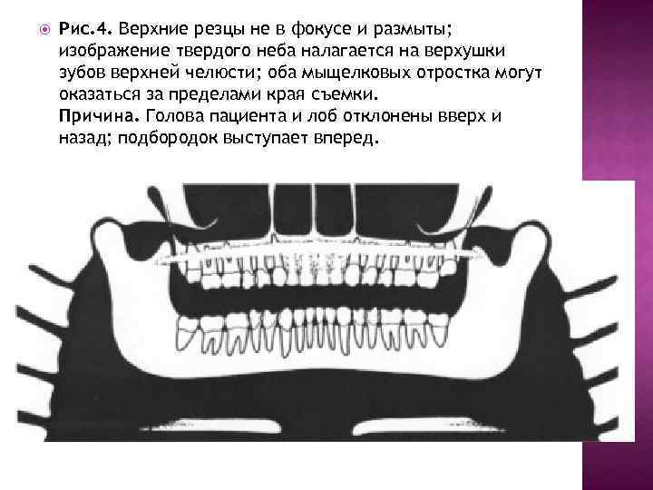  Рис. 4. Верхние резцы не в фокусе и размыты; изображение твердого неба налагается