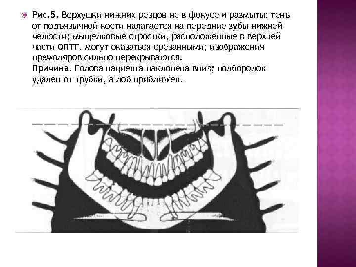  Рис. 5. Верхушки нижних резцов не в фокусе и размыты; тень от подъязычной