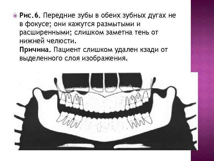  Рис. 6. Передние зубы в обеих зубных дугах не в фокусе; они кажутся