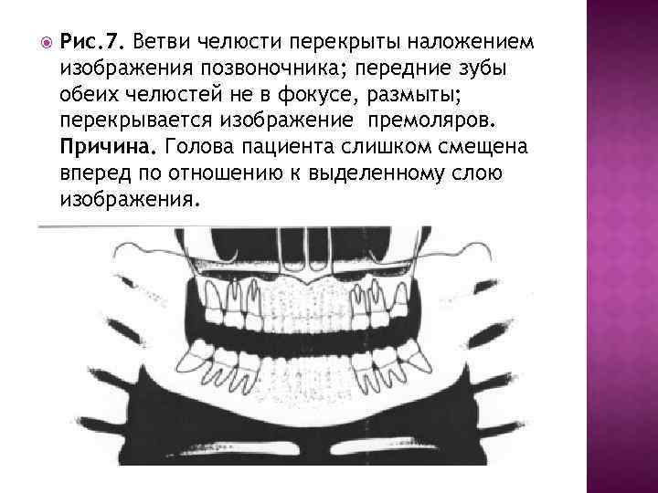  Рис. 7. Ветви челюсти перекрыты наложением изображения позвоночника; передние зубы обеих челюстей не