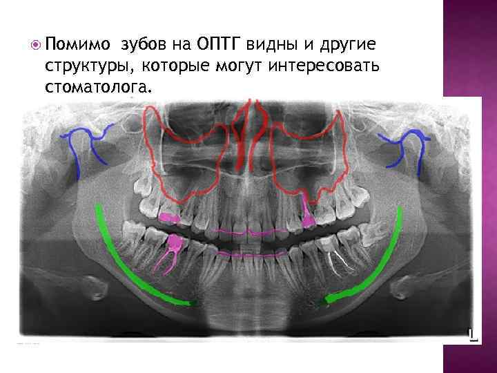  Помимо зубов на ОПТГ видны и другие структуры, которые могут интересовать стоматолога. 