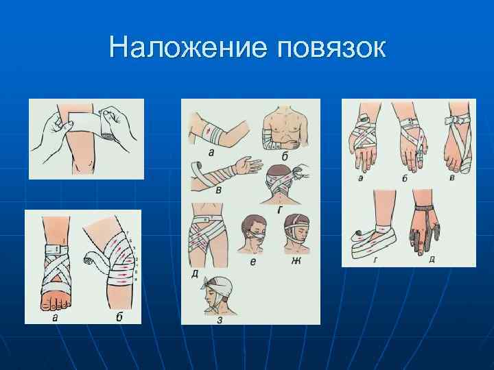 Наложение повязок 