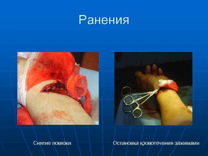 Ранения Снятие повязки Остановка кровотечения зажимами 